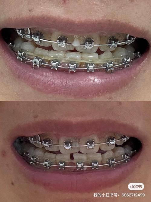 马鞍山鼎植口腔医院牙齿修复及基础治疗项目价格