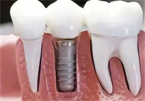 广州柏德口腔医院收费标准详解