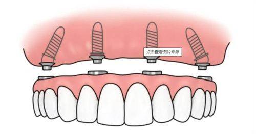 据说柏德口腔种植牙可靠收费价格也不贵