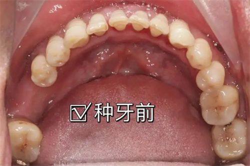 太原鼎植口腔医院:种植牙医生实力强大