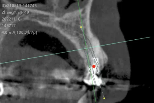 郴州青春口腔种植牙价格表