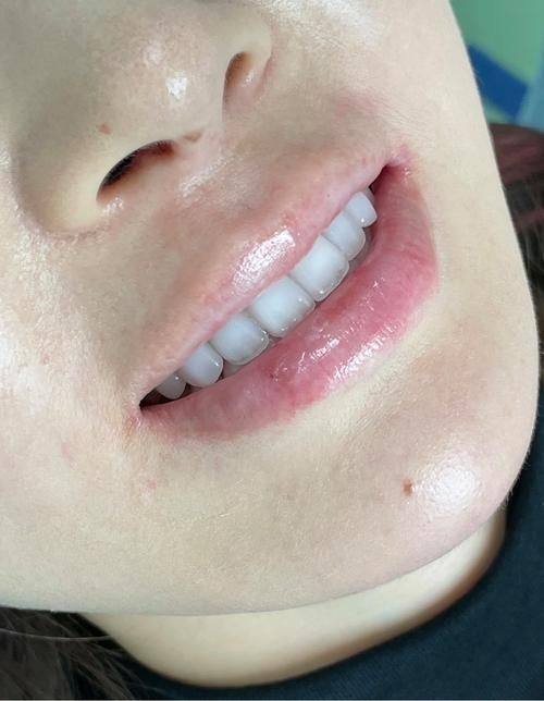 合肥佳德口腔医院牙齿修复项目价格