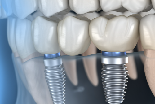 广州广大口腔种植牙贵吗？其实价格合理，性价比高，还能享受优质种植服务！ 