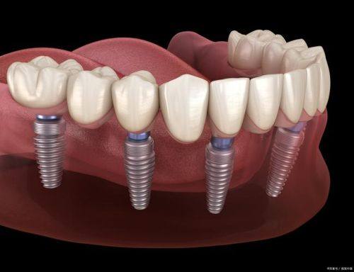 成都团圆口腔医院种植牙收费情况