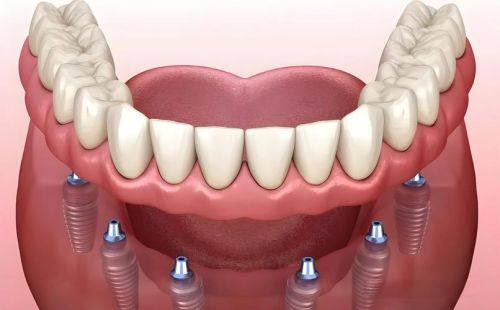 广州美云口腔医院合理的价格与良好的口碑评价