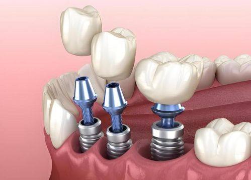 广州广大口腔医院种植牙价格合理且服务优质