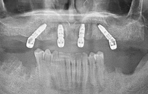 重庆团圆口腔医院牙齿矫正价格:多种选择,学生党友好