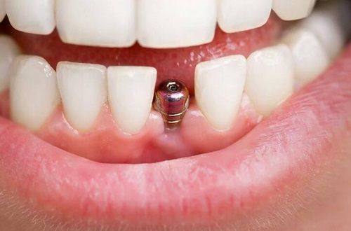 宁波牙博士口腔医院口碑咋样,口碑实力不比国有差,理想的微笑,请收好医院实例