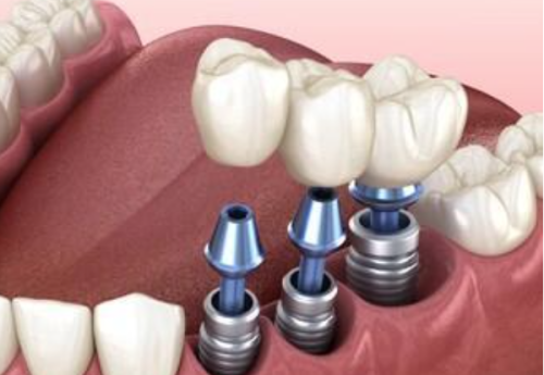 丽水亮贝美口腔是正规牙科 - 私立机构口碑TOP3,卫健委资质 + 种牙活动价曝光