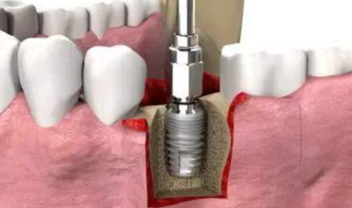 浙江义乌精齿口腔门诊部价格贵吗多少钱？