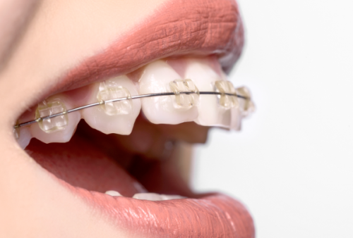 长沙中诺口腔医院牙齿矫正项目价格及亮点