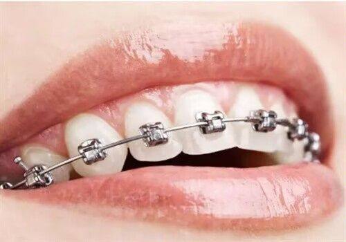 郴州科尔雅口腔医院牙套矫正价格及方式