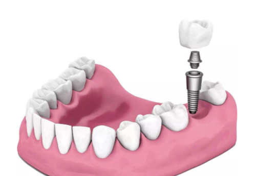 北京口腔医院种植牙收费情况