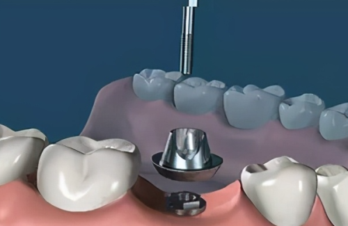 合肥美奥口腔医院矫正和种牙技术都不错