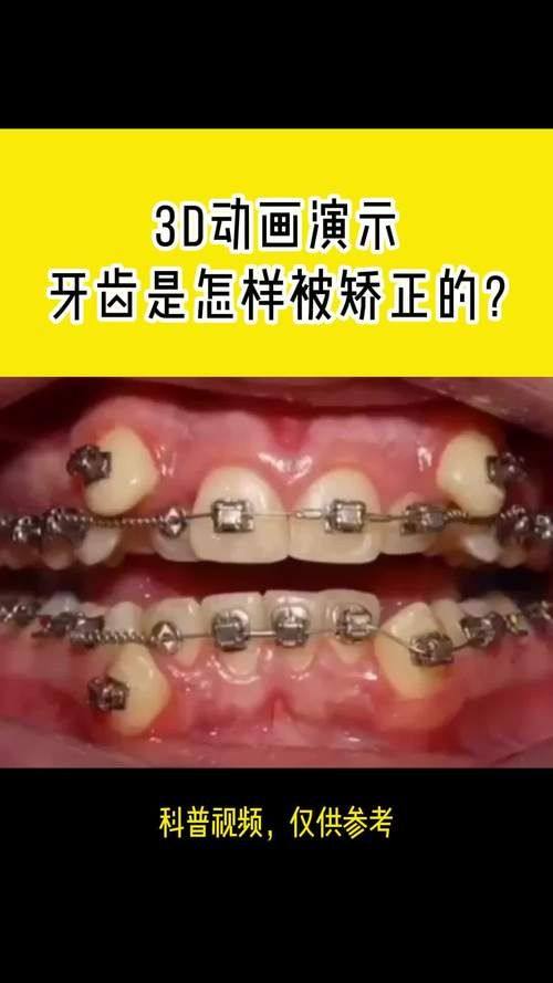 郴州市牙套价格及优势