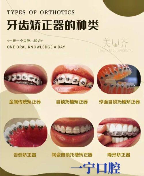 郴州戴牙套大概多少钱？看完这篇，让你清楚不同牙套类型的大致花费情况 