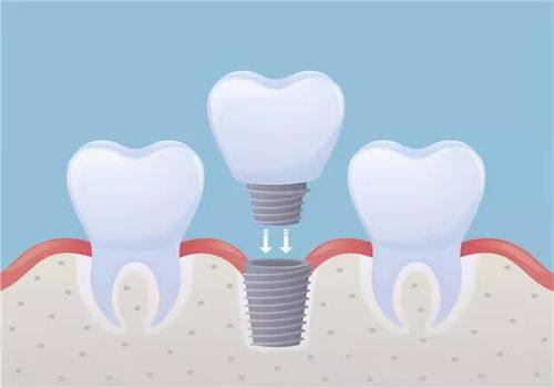 深圳麦芽口腔南山机构被传“骗局”?卫健委核查+患者数据实锤:种牙5年留存率高,价格还低!