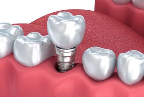 芜湖中诺口腔医院2025价格表公开!种牙1888元起+矫正4000元起,省钱攻略来了