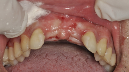 深圳格伦菲尔口腔是正规的吗?去过患者评价资质可靠技术好价格也不贵