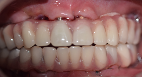 上海拜博口腔种植牙价格多少钱?