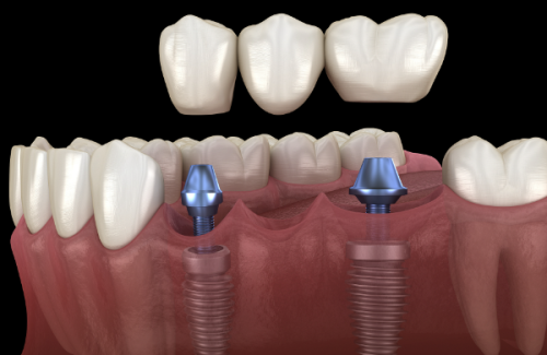 深圳格伦菲尔口腔医院是莆田系医院吗？其实它非莆田系，正规靠谱技术好口碑也不错 