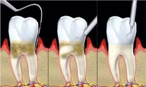 磕掉牙补牙大概要多久？损伤程度、牙槽骨状况及修复方案说了算