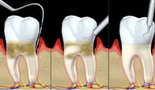三、根管治疗是不是都要打桩