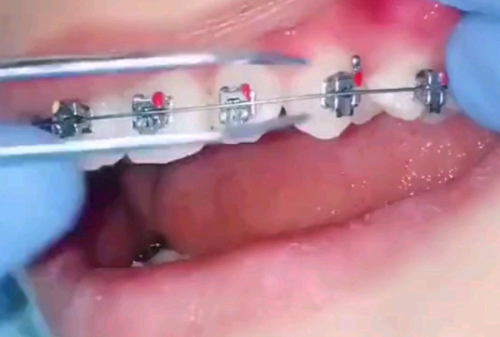 三、什么情况下需要放弃保牙，选择种植牙修复？