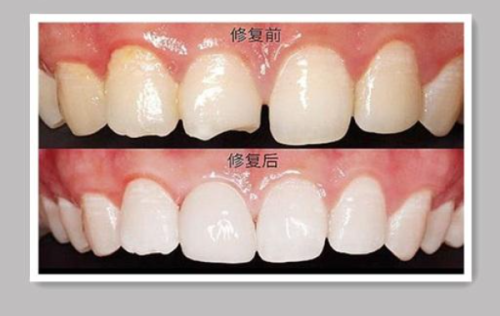 三、钻洞位置对门牙术后的影响及修复建议