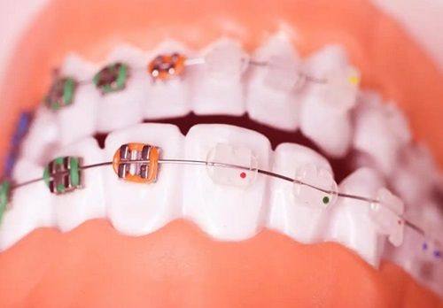 二、超声波洗牙和喷砂洗牙的核心差异