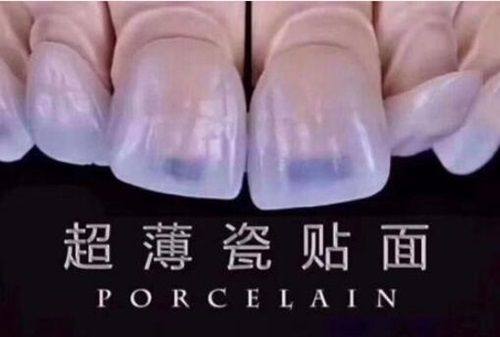 五、补牙时长相关常见疑问解答