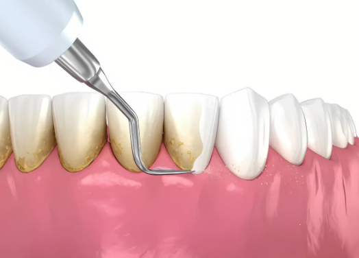 二、烤瓷牙粘歪了能不能重新粘接？分情况处理