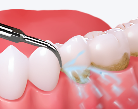 五、韩国DIO种植牙的优缺点（韩系植体的利与弊）
