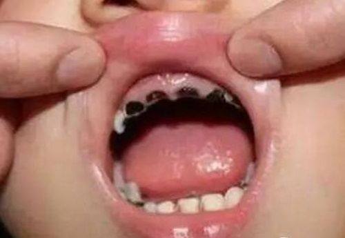 三、影响拔牙后种植时间的关键因素