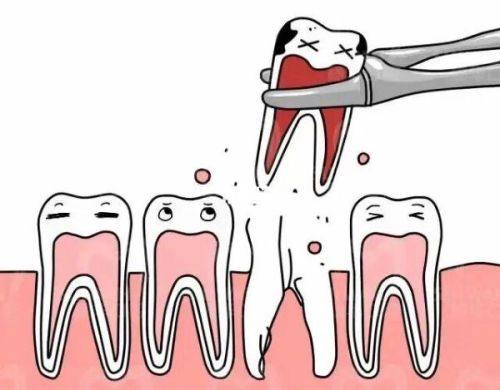 三、保护血凝块：避免干槽症的关键