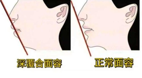 三、不同隐形矫正版牌/技术对拔牙决策的影响