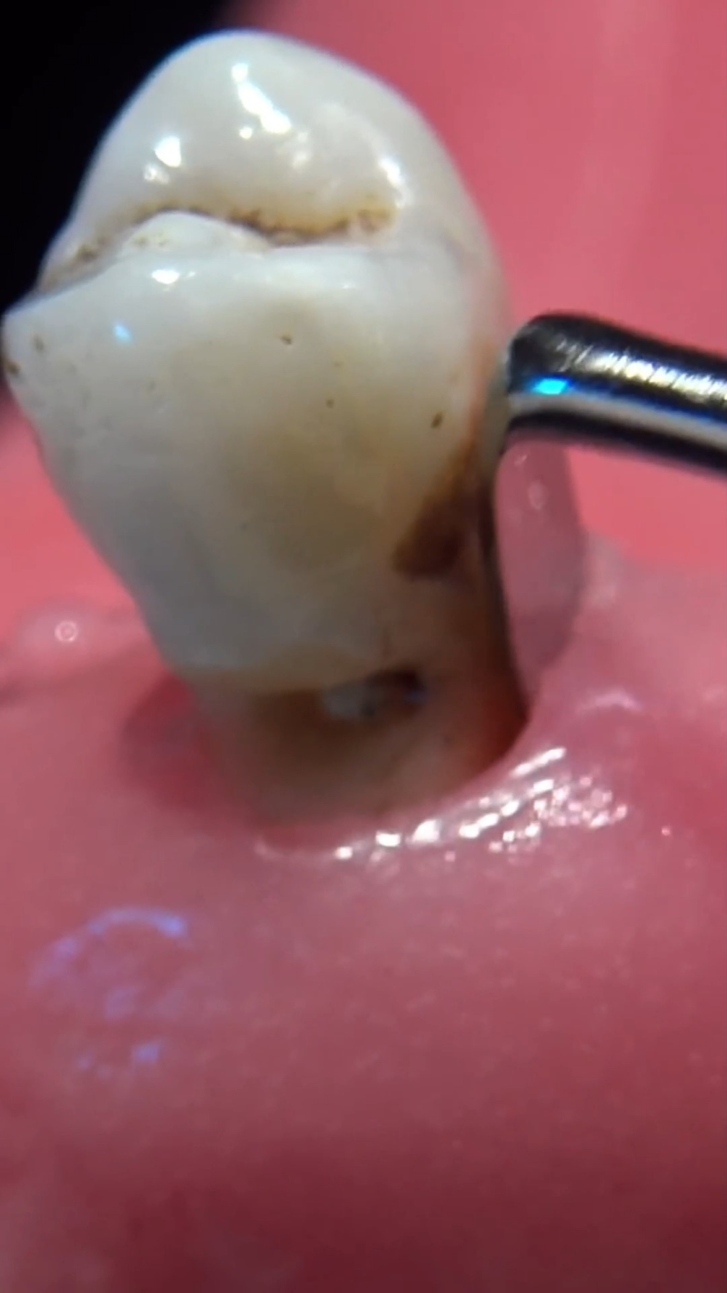 二、不同补牙材料的特性对比:哪种材料更好?