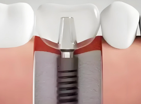 种植牙登腾一颗多少？3999套餐含啥？5000够不够？费用影响因素揭秘
