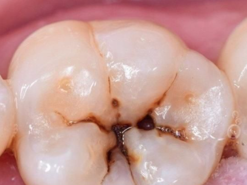 二、洗牙去除牙结石的主流方式