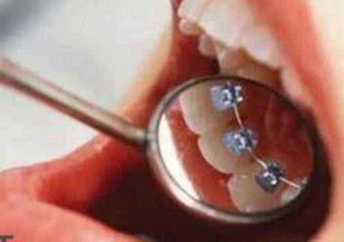 四、智齿的拔牙时机