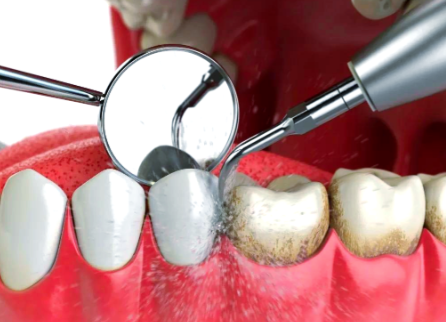 两颗种植牙中间搭桥一颗好吗？7k-6w费用+5-10年寿命，适配情况全解析