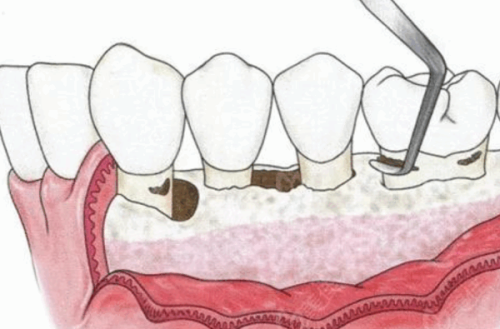 这些异常信号，也提示拔牙后可能感染