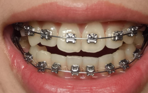 二、从硬度差异看根管治疗与种植牙的核心区别