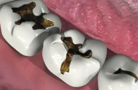 根据地包天类型，39岁矫正选对应方案