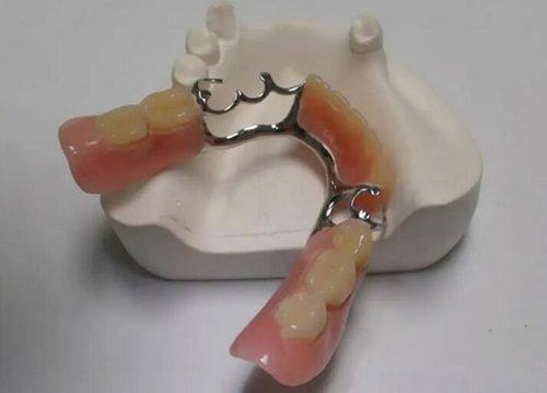 四、连排烤瓷牙掉了一颗的费用明细