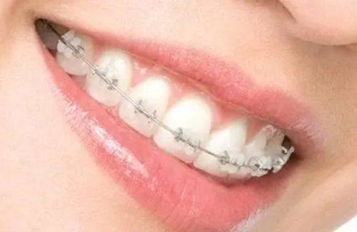 二、临床主流：牙源、功能、骨源三类地包天详解