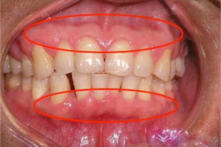 二、拔牙拍牙片和ct有什么不同：从适用场景看差异