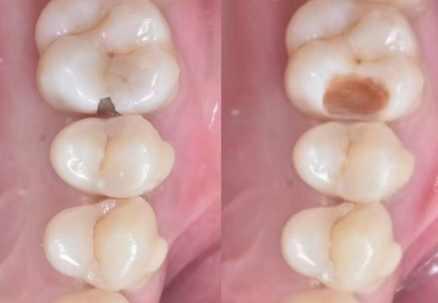 家用洗牙器什么牌子好？好用又实惠的品牌推荐及全场景热门款选购指南