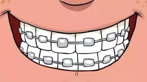 五、矫正方法选择：不同牙套类型，周期差异明显