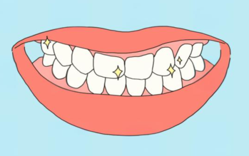 拔牙后多久可以补牙龋齿、蛀牙、牙洞？可即刻树脂修复，建议咨询医生